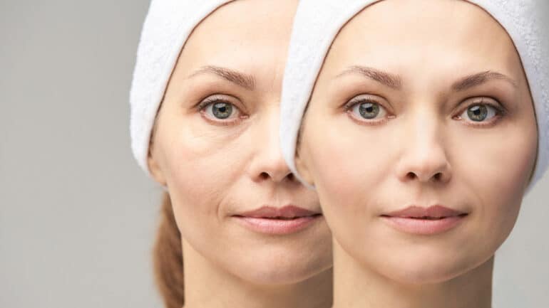 Before and after wrinkle treatment photos of a middle aged woman
