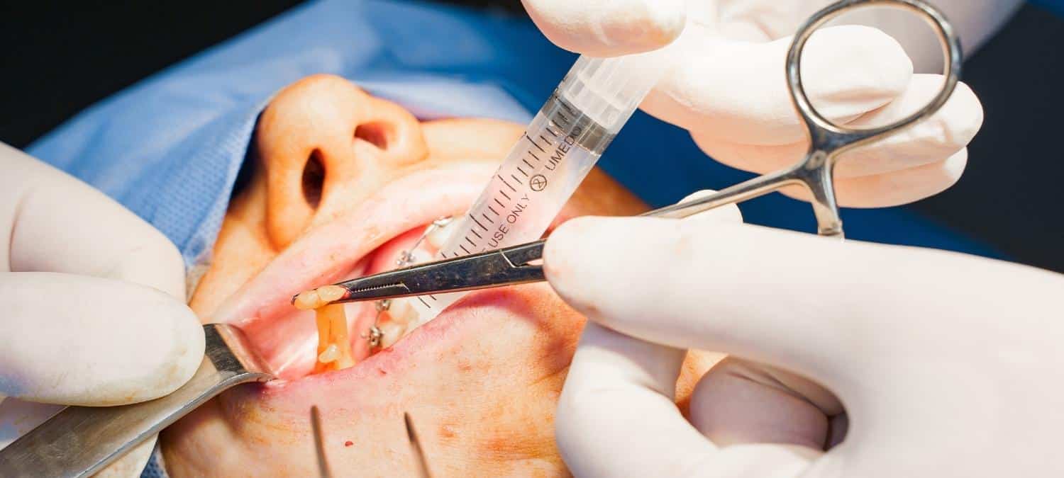 woman having buccal fat removal surgery performed on her face