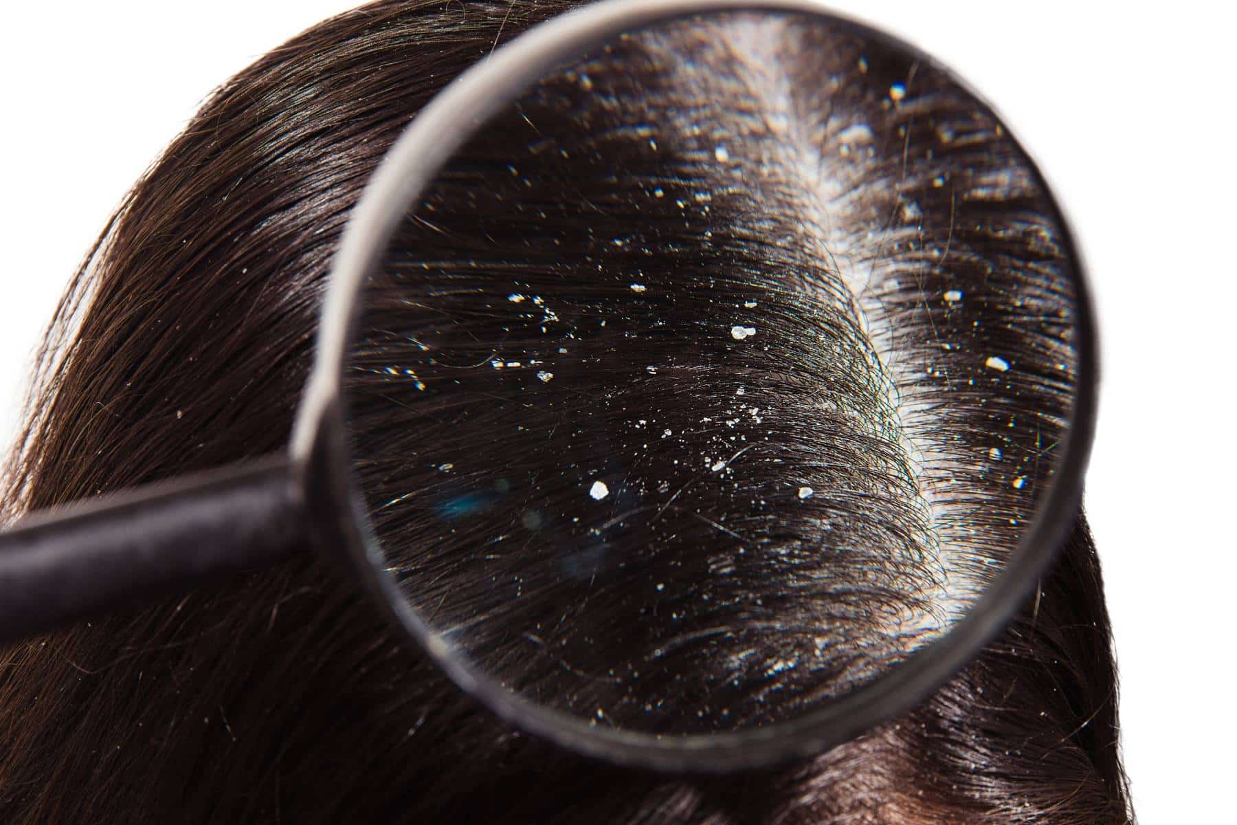 closeup of a scalp with dandruff