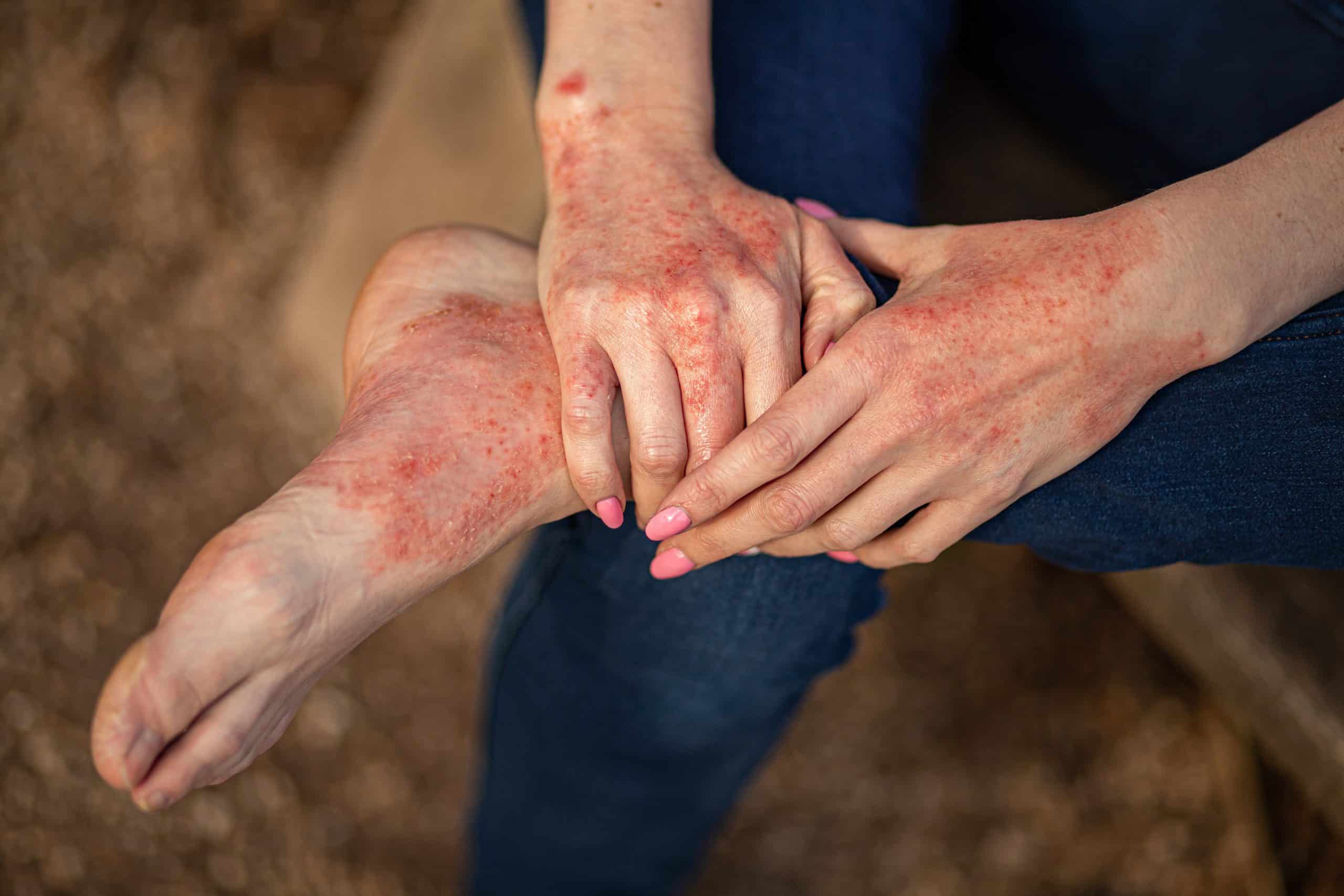A woman with eczema examines her hands and foot.